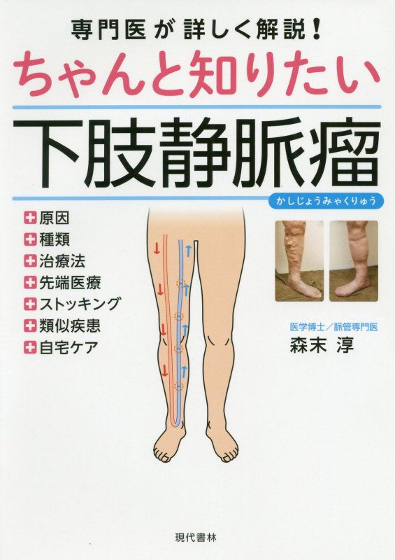 ちゃんと知りたい下肢静脈瘤　専門医が詳しく解説！　